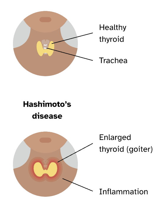 Is Hashimotos Disease Genetic Genetic Testing For Hashimotos Disease