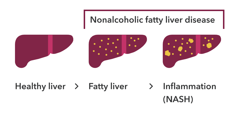 Is Nonalcoholic Fatty Liver Disease Genetic?