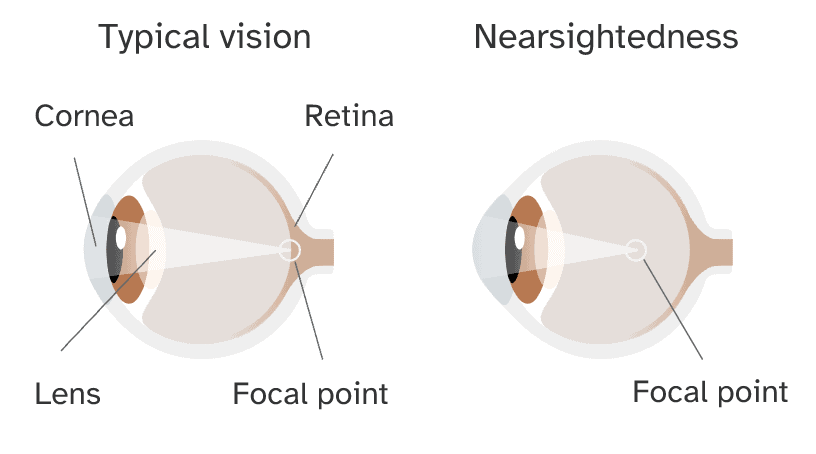 Nearsightedness Genetics And More 23andme 3311